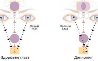 Диплопия. Причины, симптомы и лечение заболевания глаз, клинические рекомендации