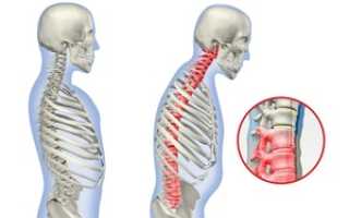 Болезнь Бехтерева: что это такое, ее симптомы