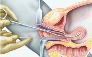 Аспирационная биопсия эндометрия (АБЭ). Что это такое