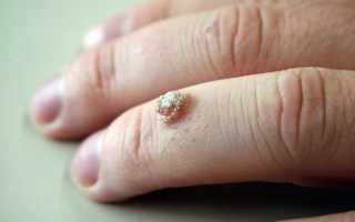 Бородавка на пальце руки — как избавиться: 5 современных способов вывести бородавку на руке