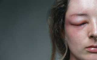 Одутловатость лица. Причины какого заболевания, как избавиться. Фото, лечение