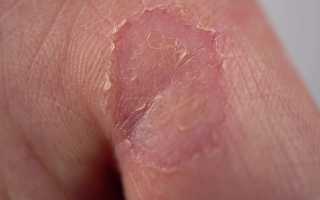 Сухость и шелушение кожи на пальцах рук. Причины и лечение кожи рук