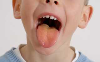 Желтый язык у ребенка, налет. Почему, что означает