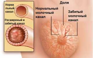 Шишка в грудине у женщин. Что это может быть, болит при нажатии, кормлении, как лечить