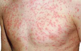 Корь у взрослых. Фото сыпи, симптомы, как выглядит, лечение в домашних условиях