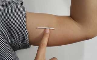 Противозачаточный имплант (подкожный контрацептив) для женщин. Цена, отзывы