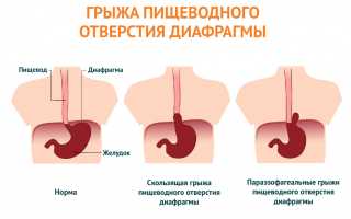 Кислый привкус во рту после еды, с изжогой и без, желтым и белым налетом на языке. Причины и лечение