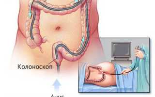 Колоноскопия кишечника. Что это, показания к обследованию, как делается, подготовка к процедуре
