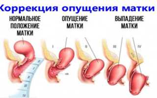 Опущение матки. Симптомы и последствия, лечение, что делать в пожилом возрасте без операции, образ жизни, упражнения