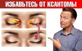 Холестериновые бляшки на лице. Как избавиться народными средствами, какие анализы сдавать