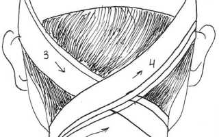 Крестообразная повязка на затылок, шею. Алгоритм, показания, фото