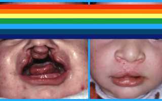 Волчья пасть у детей. Фото до и после операции, причины появления, лечение