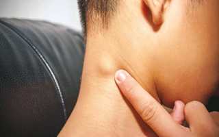 Шишка на шее под кожей, сзади, слева, справа. Фото, к какому врачу обратиться