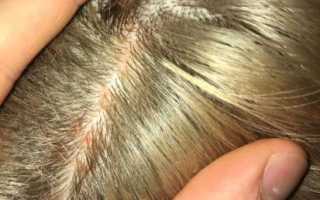 Лечение перхоти на голове народными средствами у мужчин, женщин, детей и подростков