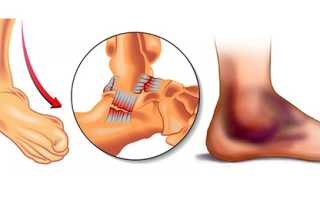 Вывих голеностопного сустава. Симптомы, первая помощь, лечение