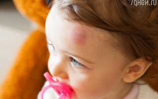 Шишка на лбу от удара. Как быстро убрать, чем мазать