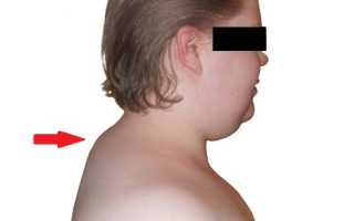 Шишка на шее сзади в области позвоночника. Как убрать, лечение, к какому врачу обратиться