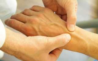 Лечение тендовагинита лучезапястного локтевого сустава