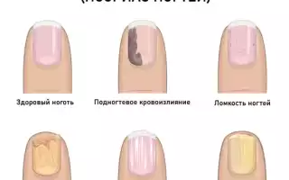 Псориаз ногтей (ониходистрофия) на ногах, руках. Фото, лечение