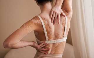 Белые пятна на коже — что это, разновидности, причины появления. Как лечить у взрослых и детей