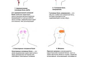 Головные боли у женщин. Причины, лечение цервикокраниалгии, сосудистых напряжений, кластерных, в виске, затылке, лобной части