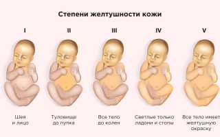 Желтуха у новорожденных. Причины и последствия, лечение в роддоме и домашних условиях