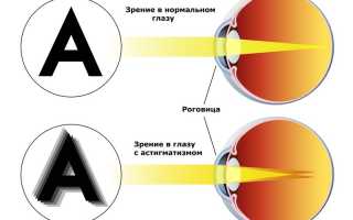 Сложный миопический астигматизм обоих глаз. Что это такое, лечение