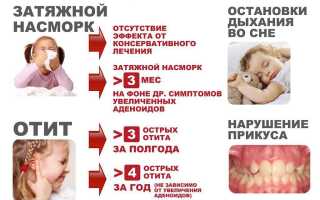 Аденоидит у детей. Симптомы и лечение, стадии: острый, подострый, хронический. Клинические рекомендации