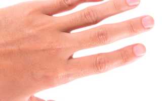Вывих пальца кисти на руке у взрослых. Признаки, как вправить