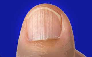 Ребристые ногти на руках у женщин. Причины и лечение, питание, уход