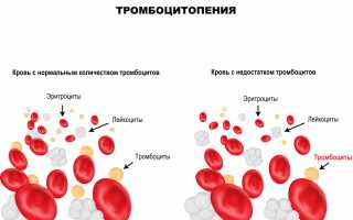 Снижение тромбоцитов в крови. Причины, о чем говорит, лечение