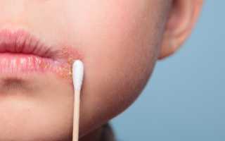 Герпес на губах при беременности в первом, втором, третьем триместре. Чем лечить, последствия для ребенка. Мнения врачей
