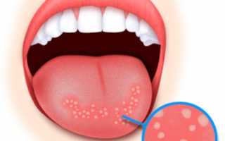 Типун на языке. Как лечить, убрать прыщик у ребенка, взрослого