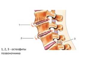 Лечение шипов на позвоночнике и симптомы остеофитов