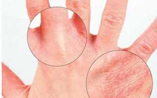 Чем лечить псориаз на руках в 21-м веке