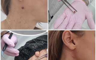 Удаление родинок на лице радиоволновое, азотом, Сургитроном. Цена