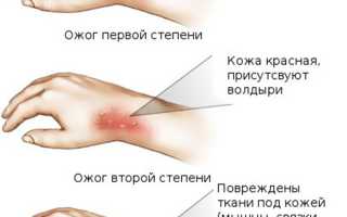 Ожог руки — что делать?