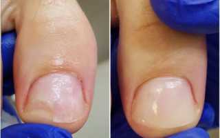 Протезирование ногтей на ногах, руках гелем Gehwol, полигелем, акрилом. Фото, цены, отзывы