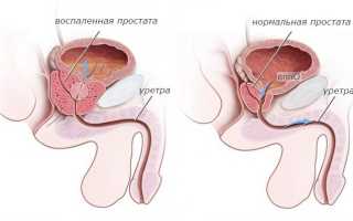 Абактериальный хронический простатит. Что это, симптомы, лечение