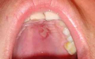 Болит небо во рту. Причины и лечение у взрослых, детей. Народные средства, мед