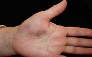 Когда Вас беспокоит боль в большом пальце руки