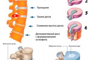 Грыжа позвоночника секвестрированная. Лечение, виды, симптомы, операция по удалению