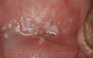 Лейкоплакия шейки матки. Отзывы, что это такое, лечение лазером, народными средствами