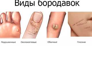 Бородавки на руках. Причины и лечение в домашних условиях. Народные средства, мази из аптеки, удаление лазером