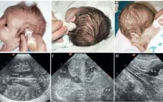Нейросонография головного мозга у новорожденных. Нормы, таблица, когда делается, расшифровка результатов