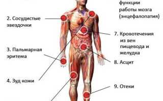 Гепатит B и C: симптомы, анализы, лечение