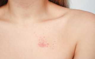 Сыпь на грудине у женщин. Причины, фото, чем лечить