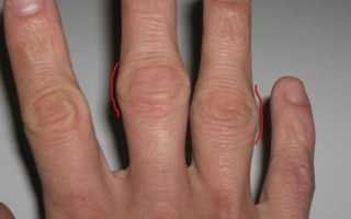 Артрит пальцев рук — что это и куда бежать?