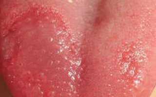 Щиплет язык. Причины и лечение у взрослого, ребенка