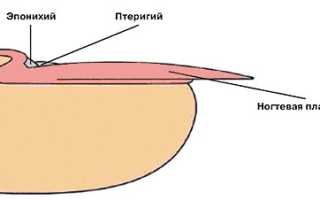 Как безболезнено удалить птеригий на ногтях рук